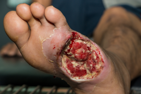 Foot wound
