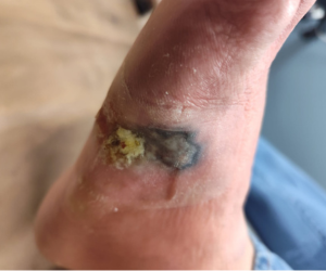 NPWT Courtesy of Podiatry Today