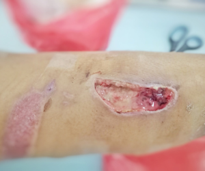 Pressure Injury Prevention: Why It Remains a Critical Patient Care Priority in Wound Care