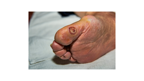Diabetic foot ulcer plantar aspect of the great toe