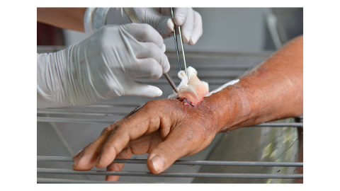 Test Your Knowledge on Debridement