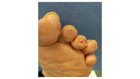 Diabetic foot ulcer on a patient's toe