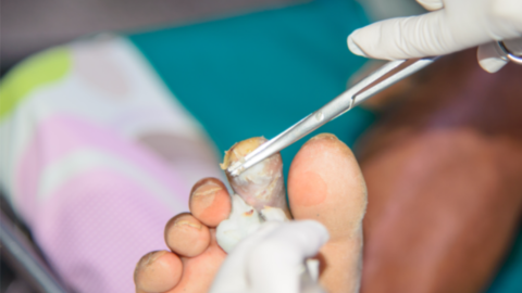 wound debridement