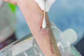 woundwound assessment - skin tear on arm assessment - skin tear on arm