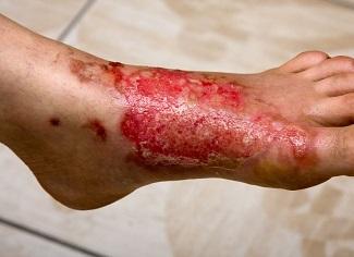 Burn Wounds Recognizing Severity Woundsource