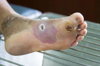 left great toe diabetic ulcer icd 10 kilenc kezelése cukorbetegség