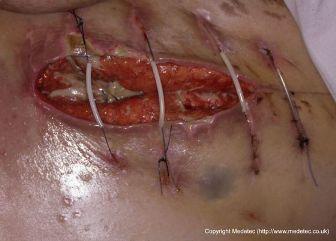 wound dihescence on abdomen