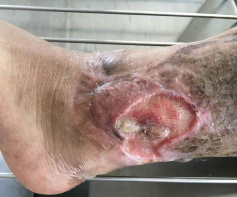 diabetic foot ulcer