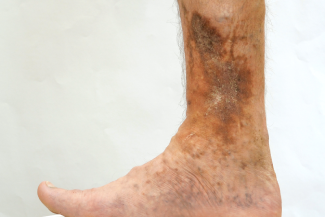 Lower Extremity Wound 