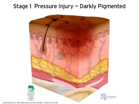 Stage 1 Pressure Injury - Darkly Pigmented Skin