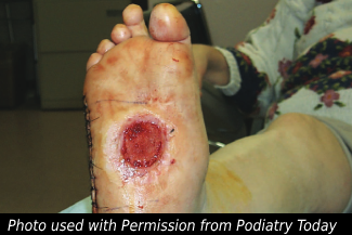 Lower Extremity Wound 