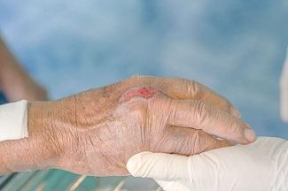 Patient Education and Wound Cleansing