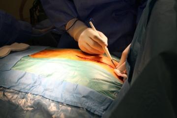 surgical site infection prevention