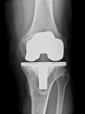 total knee replacement surgical wound healing