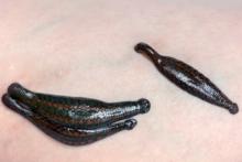 medical leech therapy