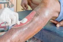 Wound Bed Assessment 