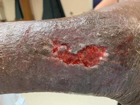 Wound Exudate Demystified: What It’s Telling You and Why It Matters 